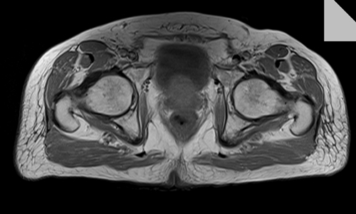 mri thigh axial  t1 image