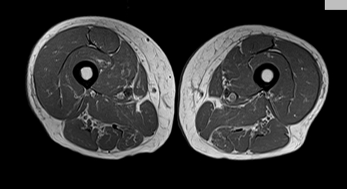 mri thigh axial  t1 image