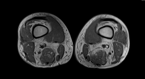 mri thigh axial  t1 image