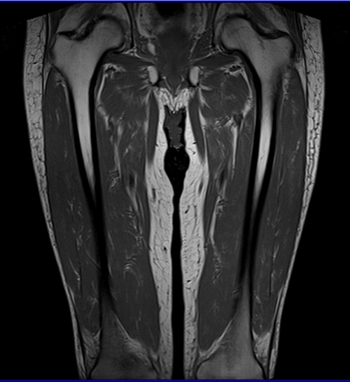 mri thigh coronal t1 image