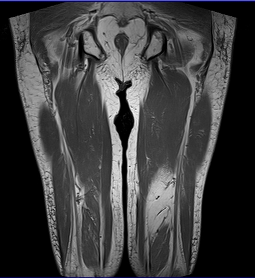 mri thigh coronal t1 image