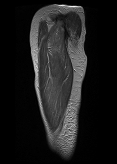 mri thigh sagittal t2  image