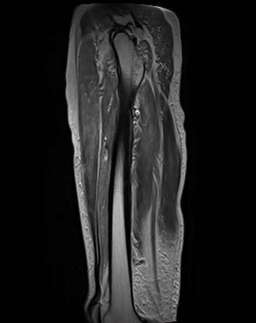 mri thigh sagittal t2  image