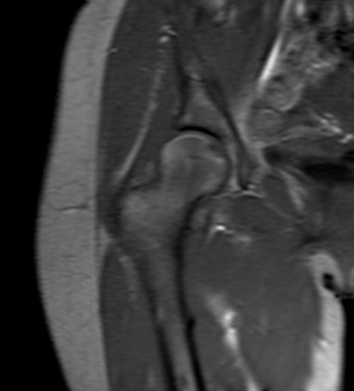 mri arthrogram localizer image 