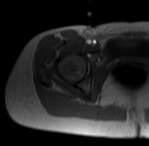 mri arthrogram localizer image