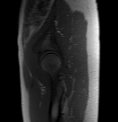 mri arthrogram localizer image