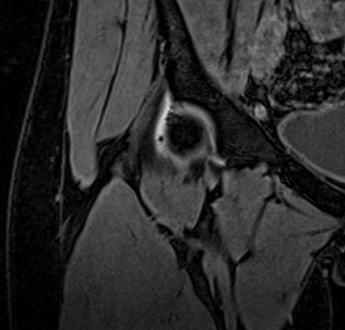  MRI arthrography coronal vibe fat sat  3d image