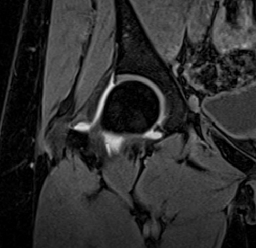 MRI arthrography coronal vibe fat sat  3d image