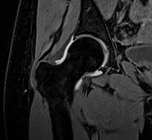 MRI arthrography coronal vibe fat sat  3d image