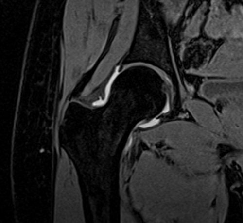 MRI arthrography coronal vibe fat sat  3d image