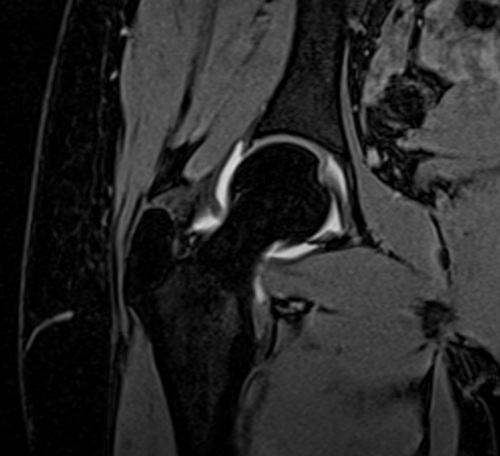 MRI arthrogram hips coronal vibe fat sat  3d image