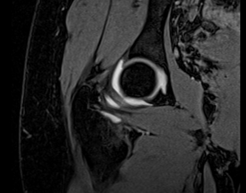 MRI arthrogram hips coronal vibe fat sat  3d image