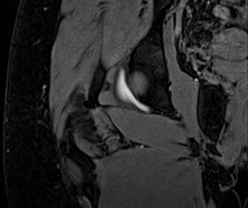 MRI arthrogram hips coronal vibe fat sat  3d image