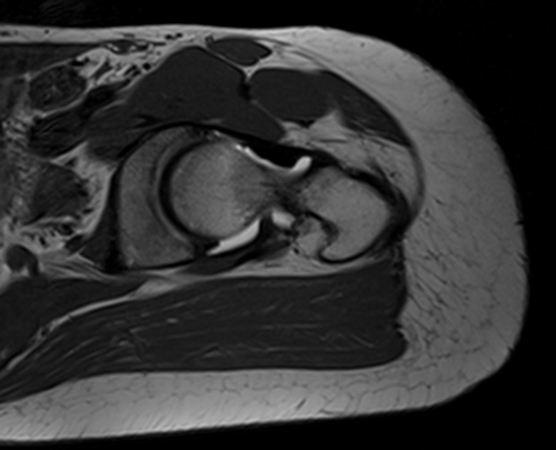 MRI hip arthrogram sagittal oblique t1  image