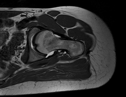 MRI hip arthrogram sagittal oblique t1  image