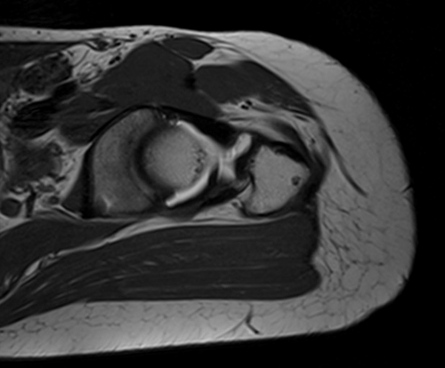 MRI hip arthrogram sagittal oblique t1  image