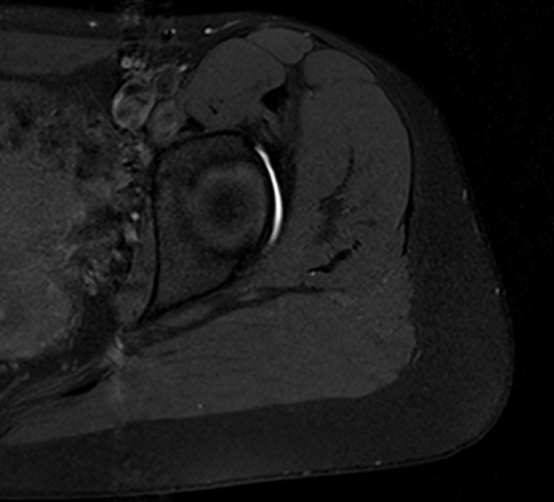 MRI hip arthrogram axial t1 fat saturated image