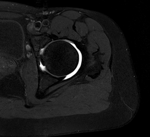 MRI hip arthrogram axial t1 fat saturated image