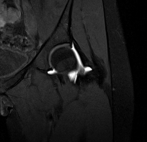 MRI hip arthrogram coronal t1 fs image