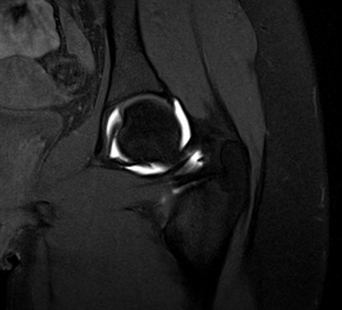 MRI hip arthrogram coronal t1 fs image