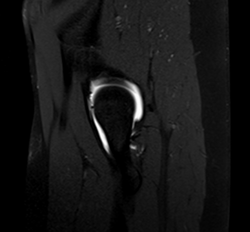 MRI hip arthrogram sagittal t1 fs image