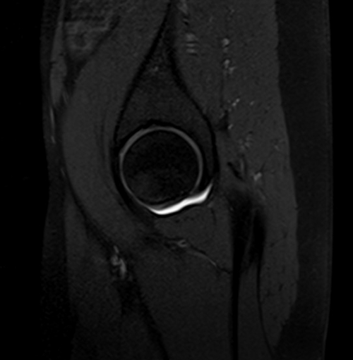 MRI hip arthrogram sagittal t1 fs image