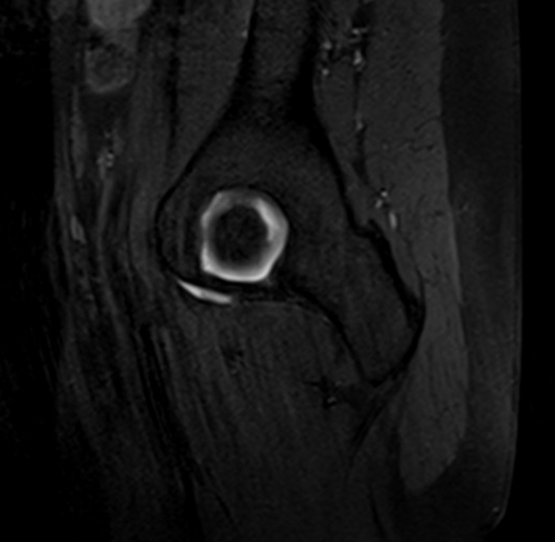 MRI hip arthrogram sagittal t1 fs image