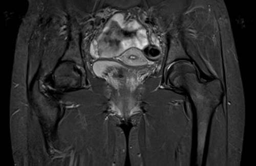 MRI hip arthrogram stir coronal 