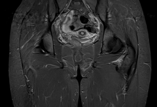 MRI hip arthrogram stir coronal