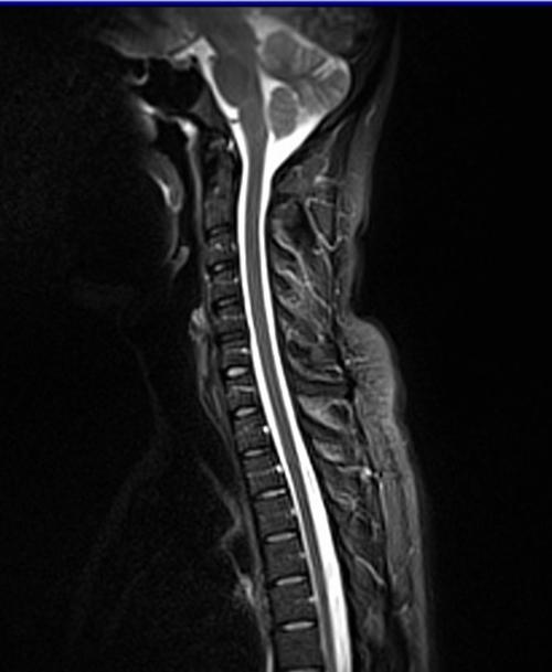 c spine sag stir image