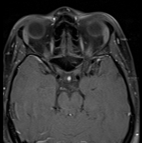 MRI face T1 fat sat axial post contrast images  