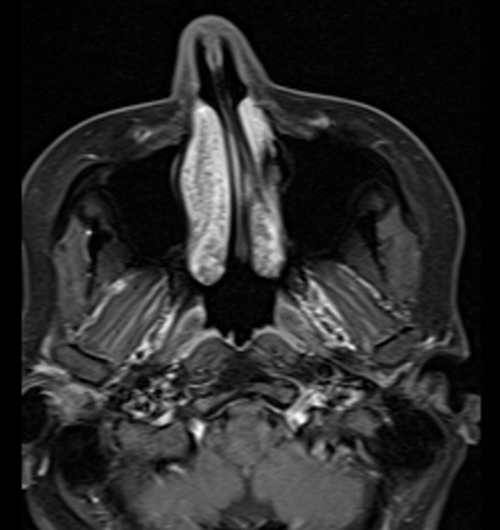 MRI face T1 fat sat axial post contrast images  