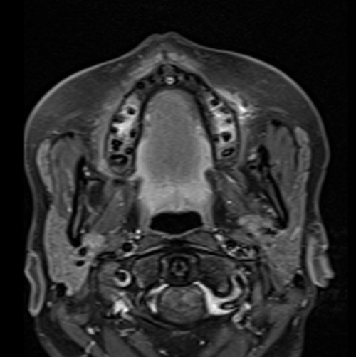 MRI face T1 fat sat axial post contrast images  