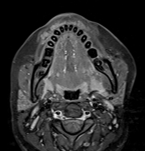 MRI face T1 fat sat axial post contrast images 