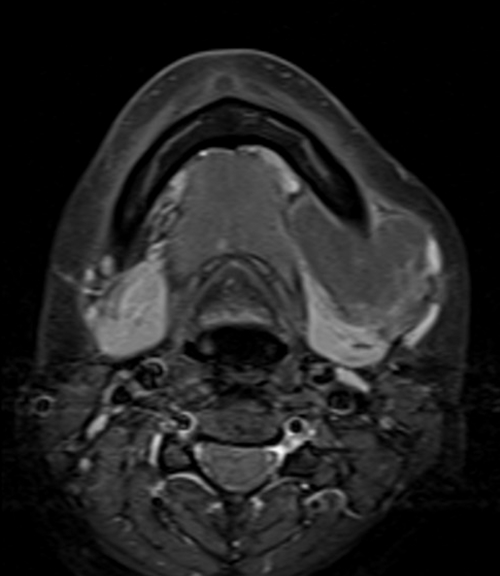 MRI face T1 fat sat axial post contrast images  