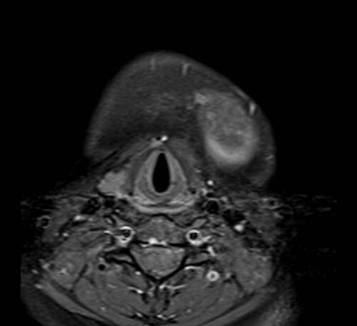 MRI face T1 fat sat axial post contrast images 