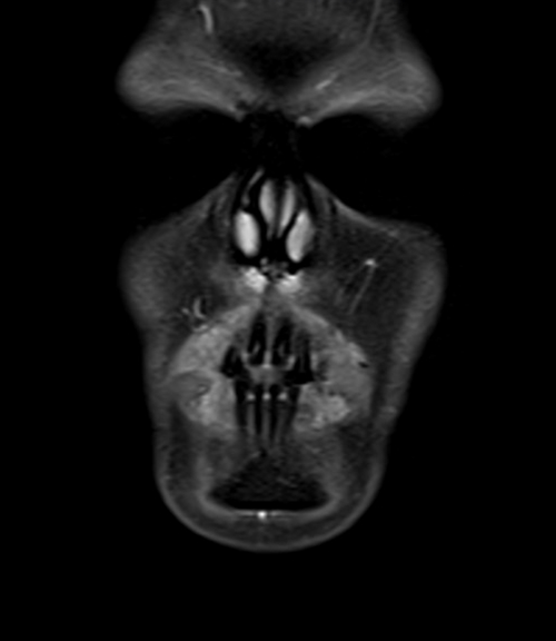 MRI face T1 fat sat coronal post contrast images 