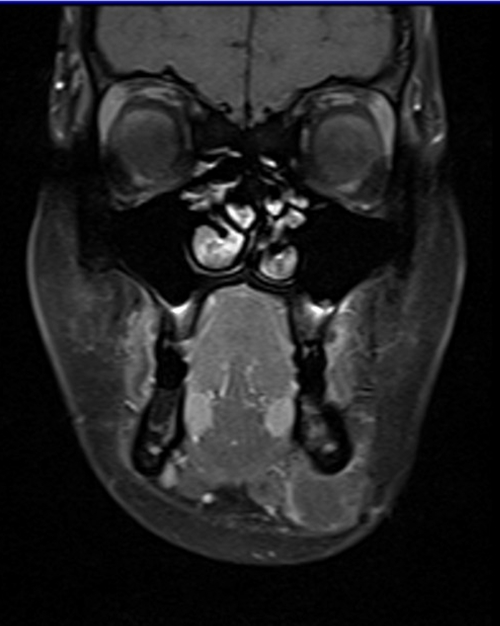 MRI face T1 fat sat coronal post contrast images