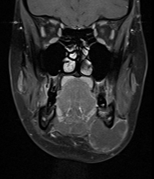 MRI face T1 fat sat coronal post contrast images 