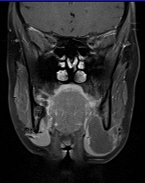 MRI face T1 fat sat coronal post contrast images