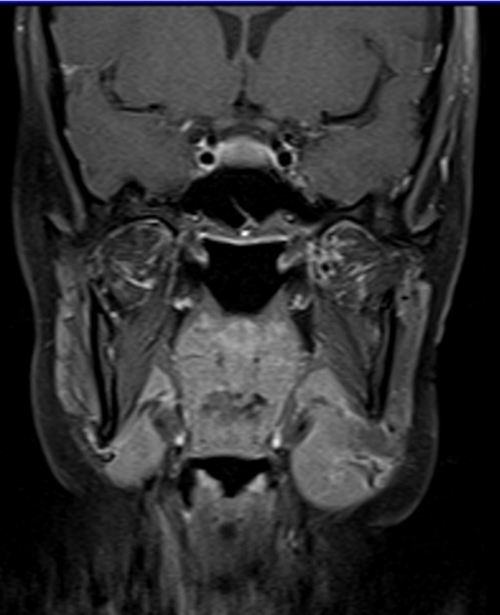 MRI face T1 fat sat coronal post contrast images 