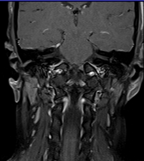 MRI face T1 fat sat coronal post contrast images 