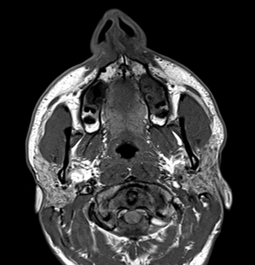 MRI face T1 axial images 