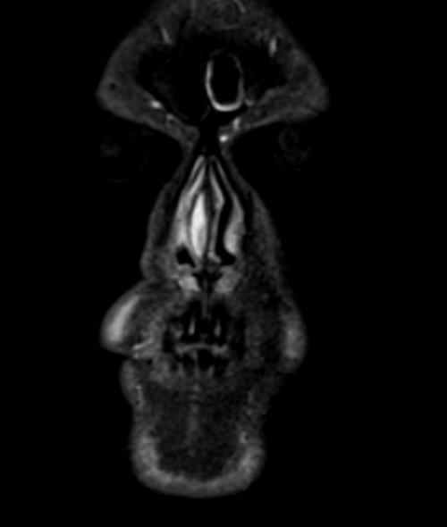 MRI face STIR coronal images  