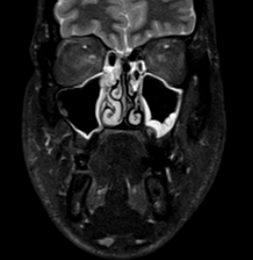 MRI face STIR coronal images  