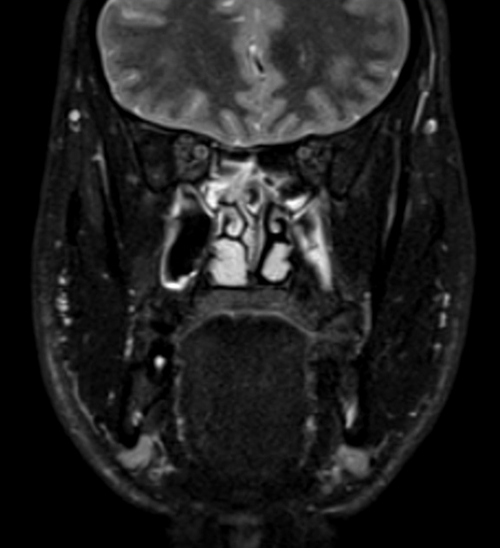 MRI face STIR coronal images 