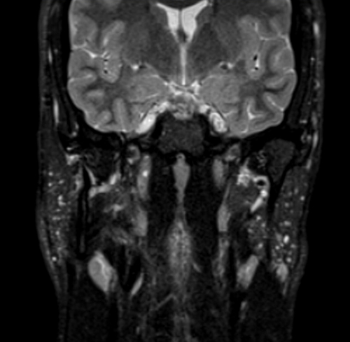 MRI face STIR coronal images 