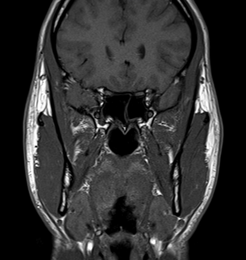 MRI face T1 axial images