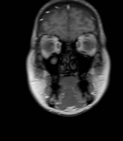 Malignant otitis externa (MOE) stir axial image 5