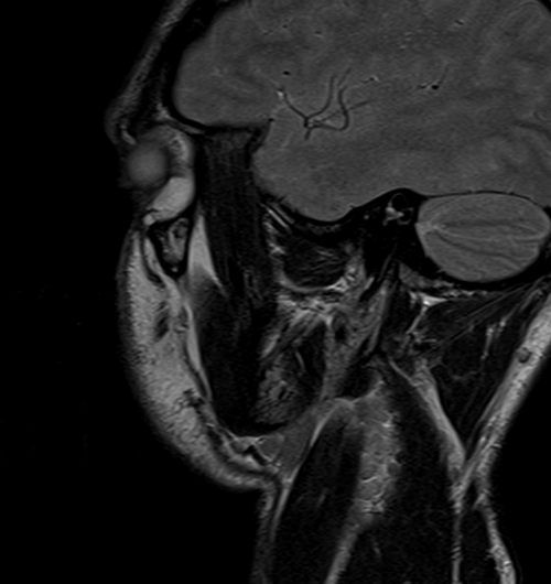 MRI face sagittal T2 images  